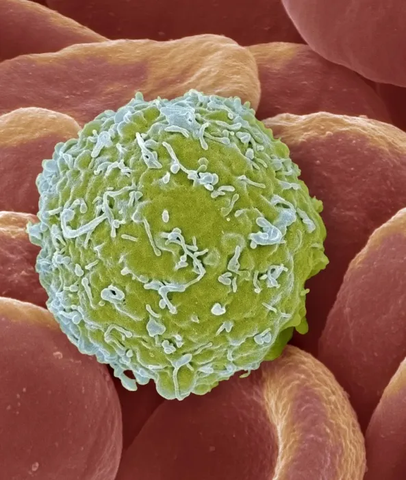 Framed Print : SEM Print of Leukaemia Cell Framed Print : SEM Print of Leukaemia Cell