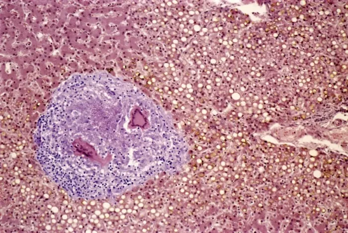 Framed Print : Light Micrograph Print of Liver Tuberculosis Framed Print : Light Micrograph Print of Liver Tuberculosis