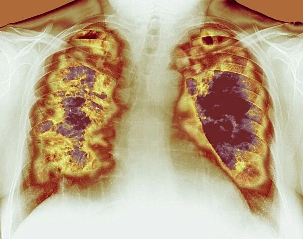 Loss of lung tissue, X-ray