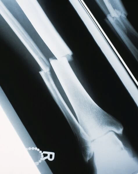 Lower leg fracture, X-ray