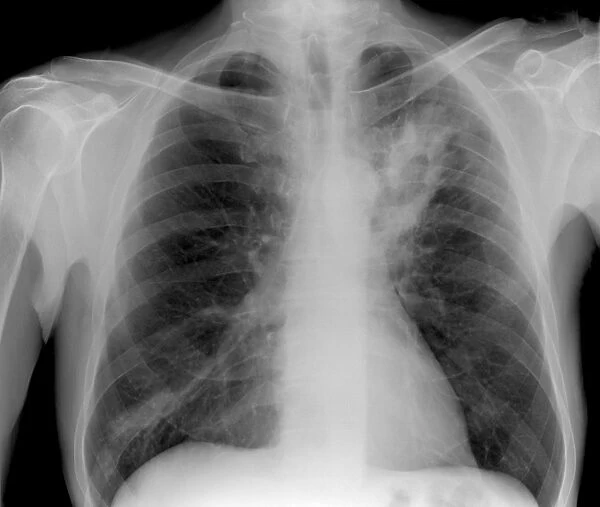 Lung abscess, X-ray