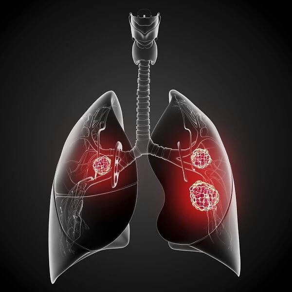 Lung cancer, artwork