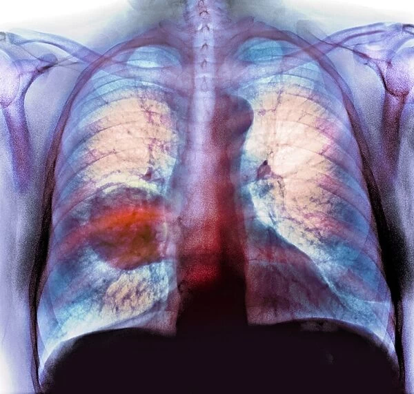 Lung cancer, X-ray C016  /  4435