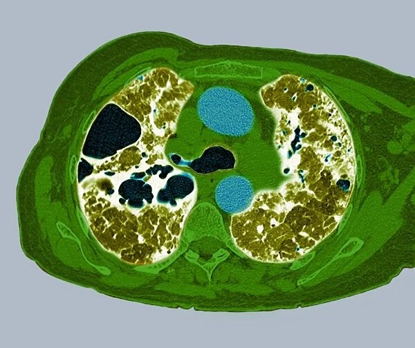Lung fibrosis, CT scan