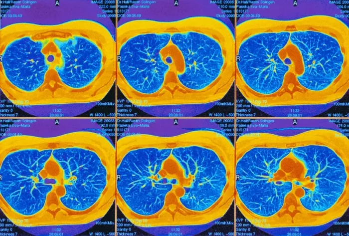 Framed Print : Axial CT Scans of the Upper Chest Print Framed Print : Axial CT Scans of the Upper Chest Print