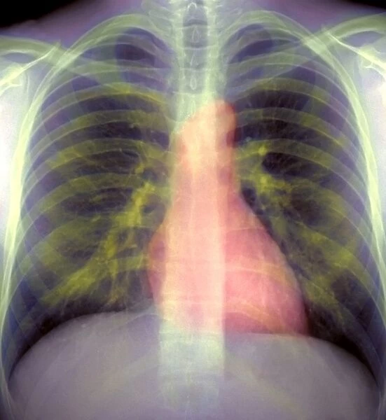 Lungs and heart, X-ray