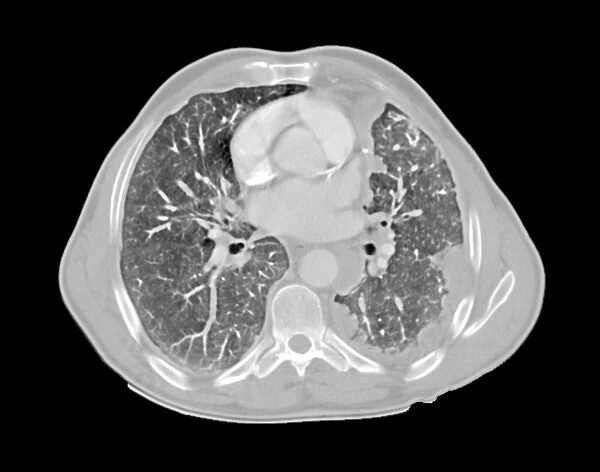 Mesothelioma lung cancer, CT scan