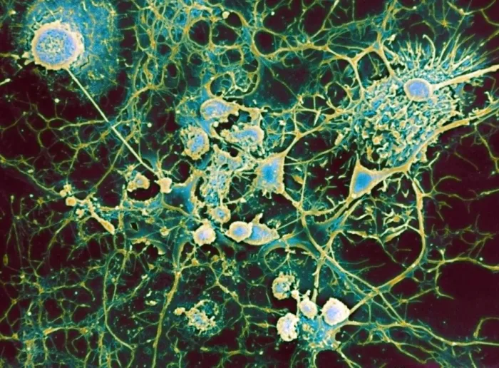 Framed Print : Multiple sclerosis Print, SEM image