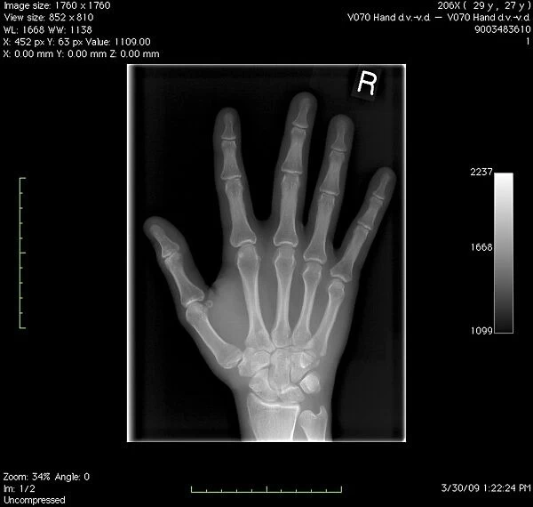 Normal hand, digital X-ray