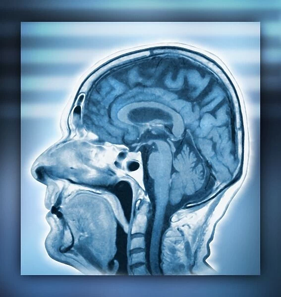 Normal head and brain, MRI scan