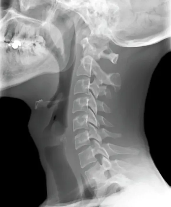 Framed Print : Normal neck, X-ray Print