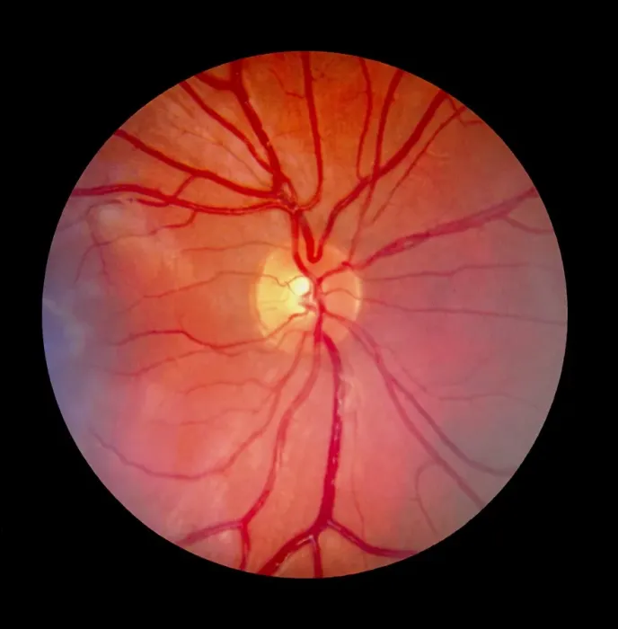 Framed Print : Normal Retina Print: Fundus Camera Image Framed Print : Normal Retina Print: Fundus Camera Image