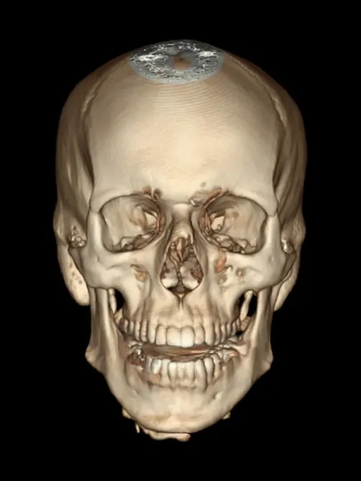 Framed Print : Normal Skull 3D CT Scan Print Framed Print : Normal Skull 3D CT Scan Print