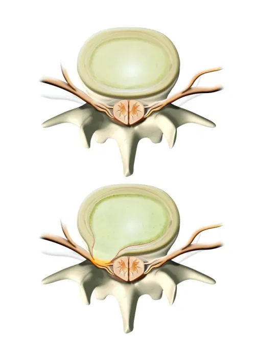 Framed Print : Normal and Slipped Disc Print Framed Print : Normal and Slipped Disc Print