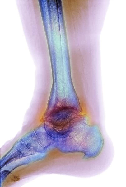 Osteoarthritis of the ankle, X-ray F008  /  3483