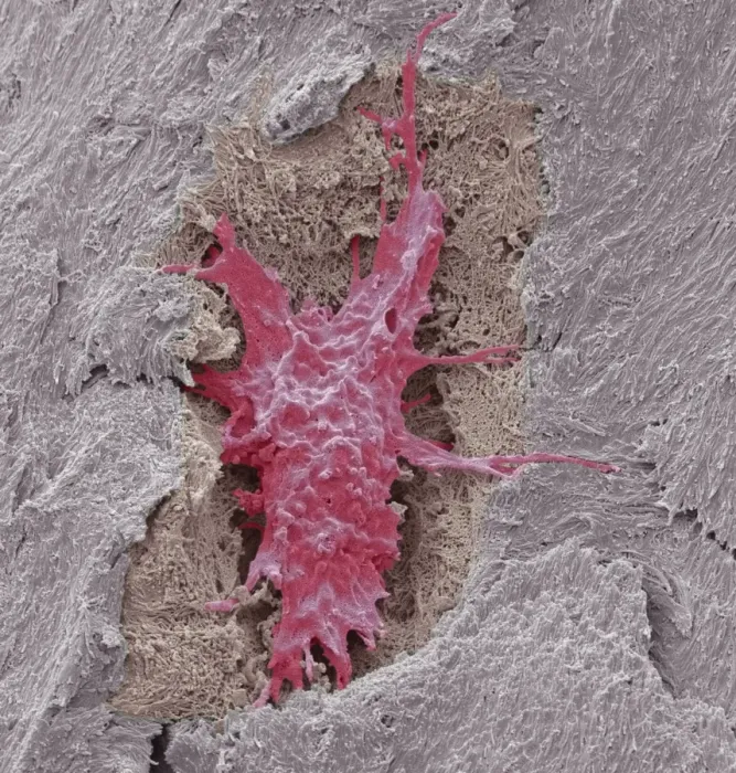 Framed Print : Coloured SEM Print of Osteocyte Bone Cell Framed Print : Coloured SEM Print of Osteocyte Bone Cell