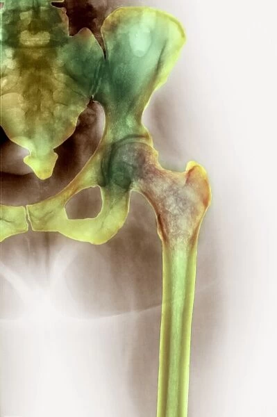 Osteoporosis of the hip, X-ray