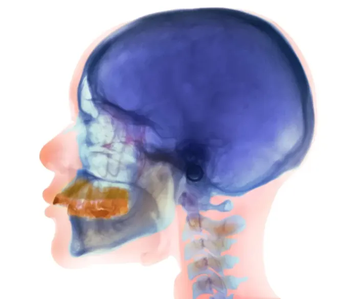 Framed Print : Coloured X-ray Print of Overbite Framed Print : Coloured X-ray Print of Overbite