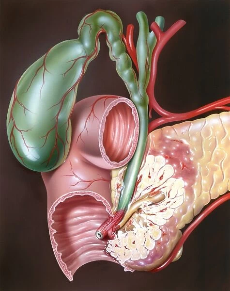 Pancreatic cancer, artwork C016  /  8735