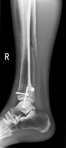 Pinned broken ankle, X-ray C017  /  7978