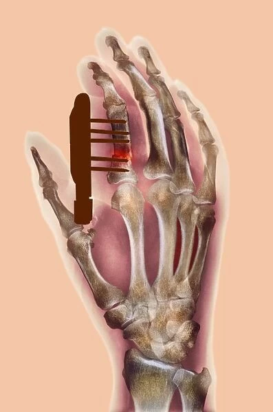 Pinned finger fracture, X-ray