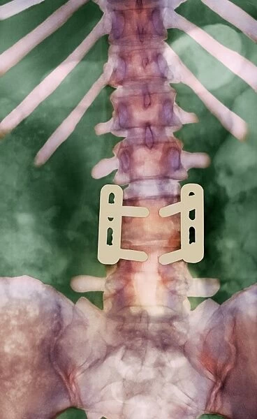 Pinned vertebrae, X-ray