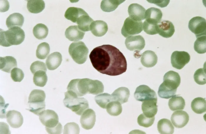 Framed Print : Plasmocyte Blood Cell Print Framed Print : Plasmocyte Blood Cell Print