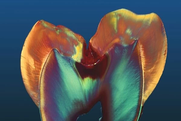 Polarised LM of a molar tooth showing decay