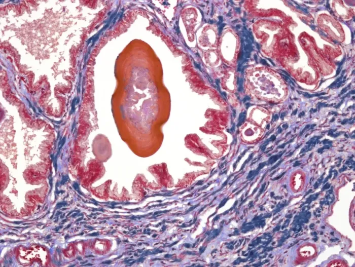 Framed Print : Prostate Print, x100 magnification Framed Print : Prostate Print, x100 magnification
