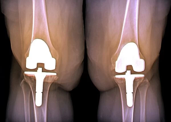 Prosthetic knees and obesity, X-ray C016  /  6598