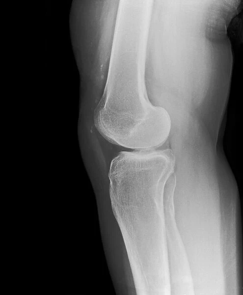 Removed kneecap, X-ray C017  /  7556