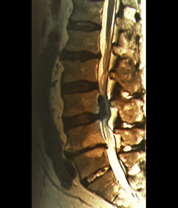Framed Print : MRI Print of Herniated Disc Causing Sciatica Framed Print : MRI Print of Herniated Disc Causing Sciatica