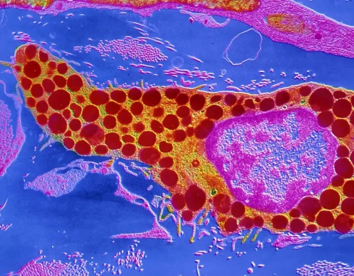 Framed Print : False-colour SEM Print of a Human Mast Cell Framed Print : False-colour SEM Print of a Human Mast Cell