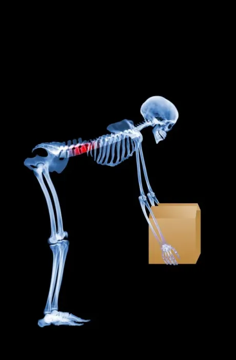 Framed Print : Skeleton lifting a box incorrectly - Print Framed Print : Skeleton lifting a box incorrectly - Print