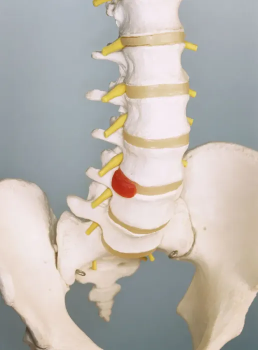 Framed Print : Slipped Disc Print: Spinal Model Framed Print : Slipped Disc Print: Spinal Model