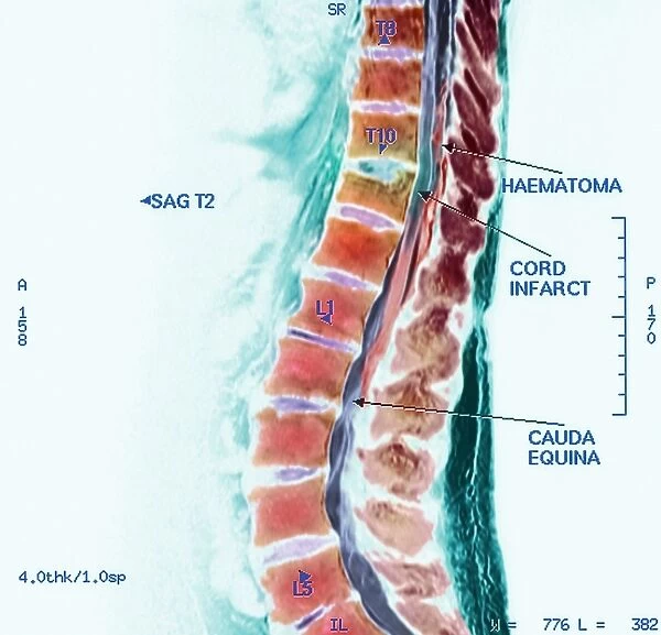 Spinal cord stroke, MRI scan