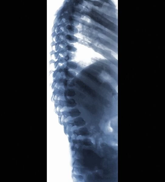 Spine in Hurler Syndrome, X-ray