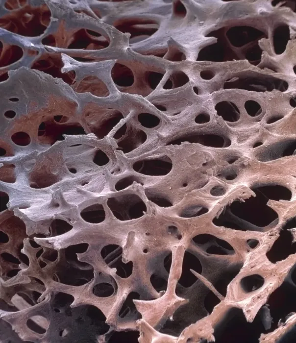 Framed Print : Spongy bone Print: Coloured SEM of human cancellous bone structure Framed Print : Spongy bone Print: Coloured SEM of human cancellous bone structure