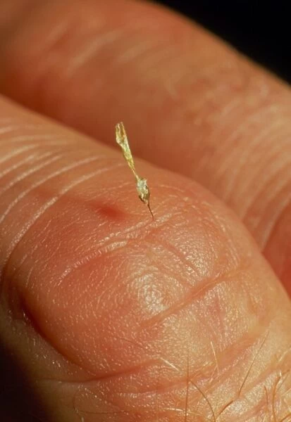 Sting of a honeybee embedded in a human finger
