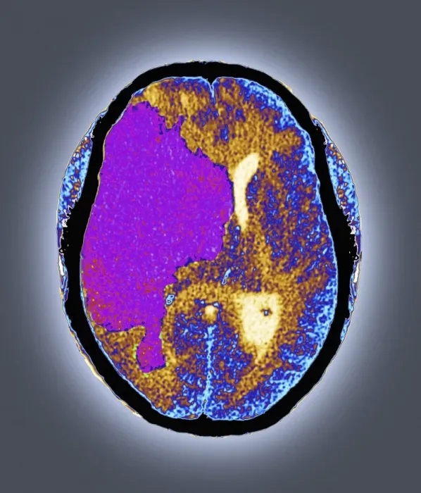 Framed Print : Coloured CT scan Print of brain damage Framed Print : Coloured CT scan Print of brain damage