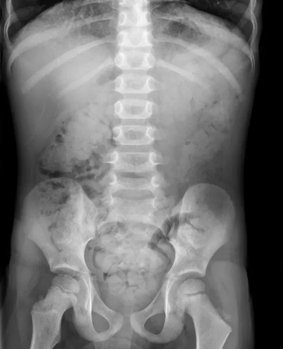 Framed Print : Swallowed Marble X-ray Print Framed Print : Swallowed Marble X-ray Print