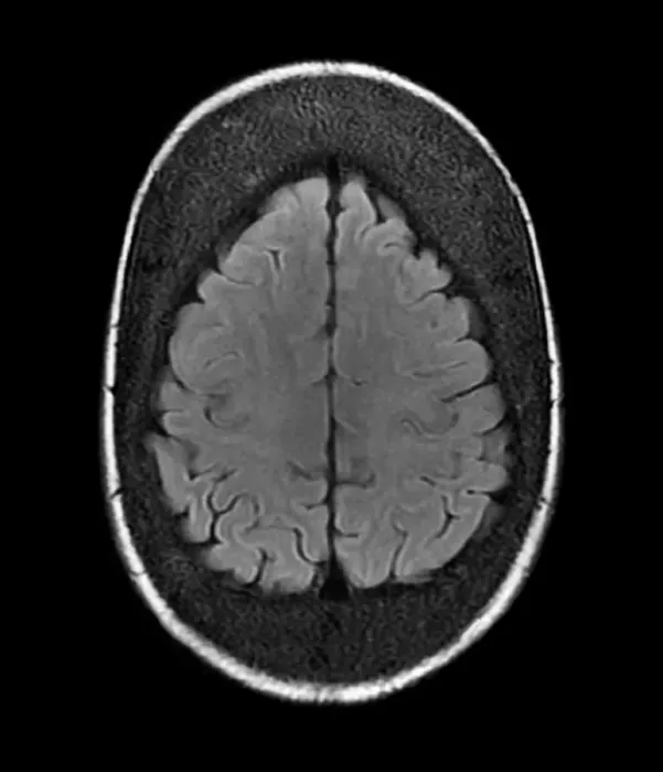 Framed Print : Thickened Skull MRI Scan Print Framed Print : Thickened Skull MRI Scan Print