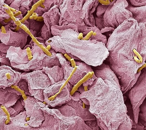 Thrush infection of the tongue, SEM C016  /  9091