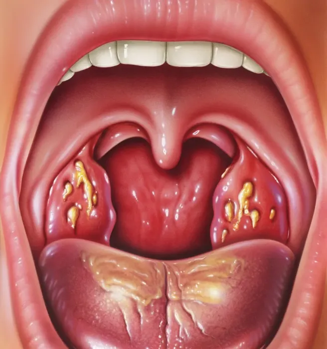 Framed Print : Tonsillitis Print Framed Print : Tonsillitis Print