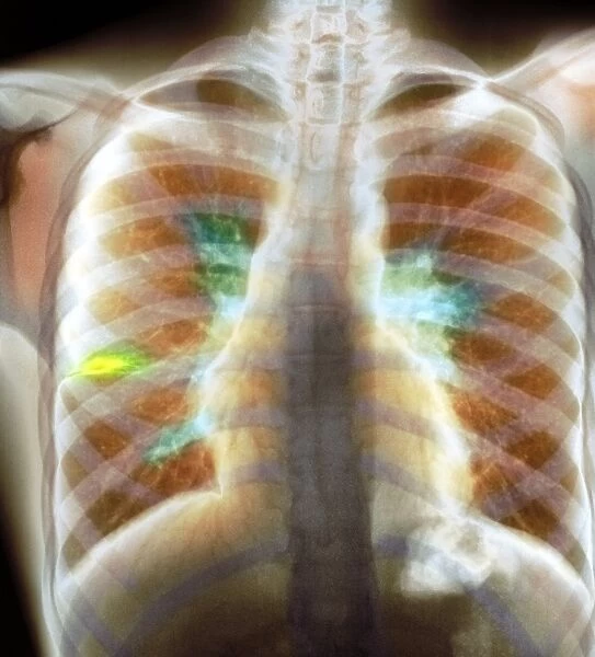 Tuberculosis lymphadenopathy, X-ray