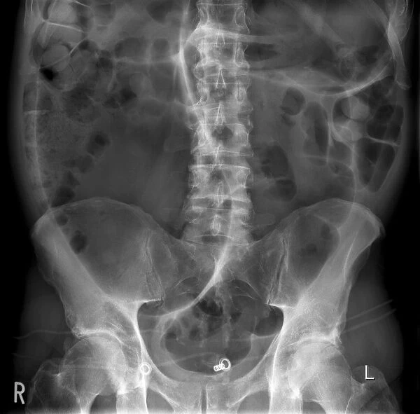 Twisted colon, X-ray C017  /  7752