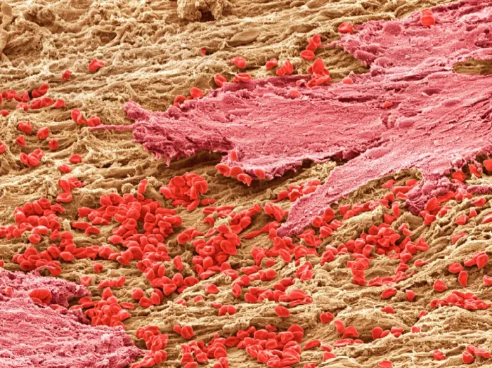 Framed Print : SEM Print of Uterus Lining during Menstruation Framed Print : SEM Print of Uterus Lining during Menstruation
