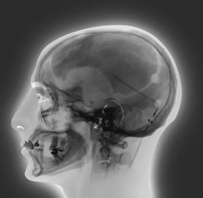 Framed Print : X-ray Print of Ventricular Shunt Framed Print : X-ray Print of Ventricular Shunt
