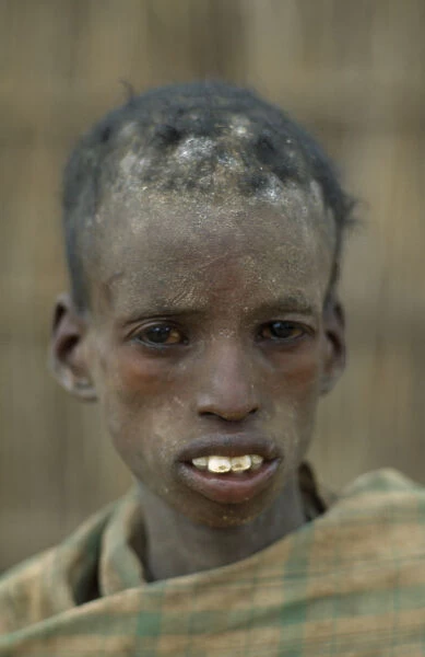 20074880. SOMALIA Baidoa Severely malnourished boy at CONCERN feeding centre. Center
