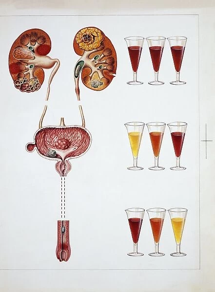 Hematuria: presence of red blood cells in urinary system, drawing